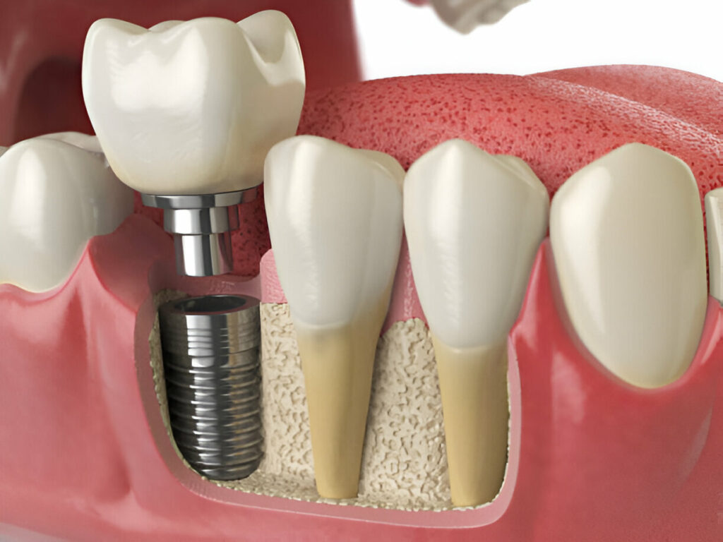 Your Step-by-Step Guide to Dental Implants at Paloma Creek Dental – Top Dentist in Aubrey, TX_1
