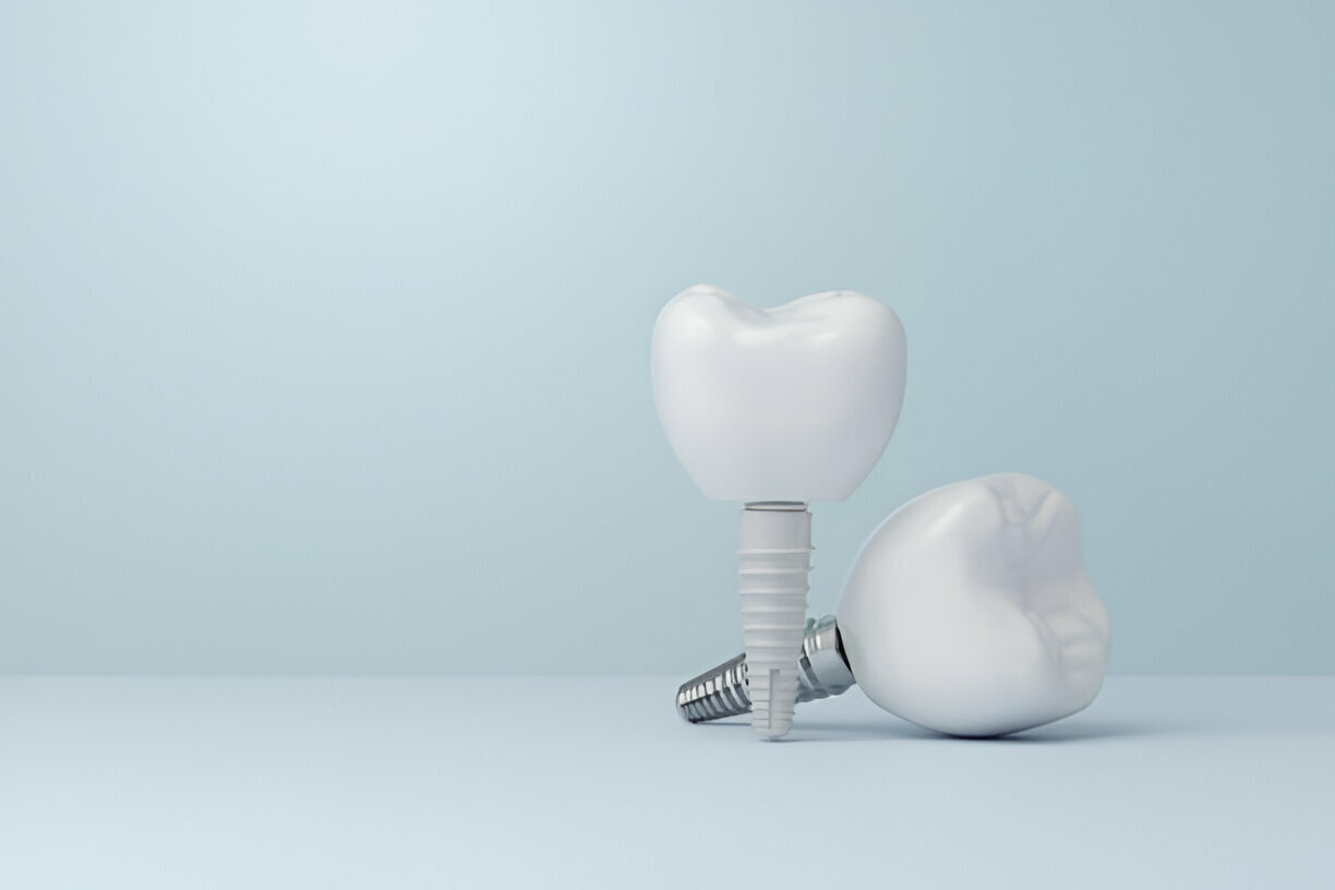 Your Step-by-Step Guide to Dental Implants at Paloma Creek Dental – Top Dentist in Aubrey, TX_FI
